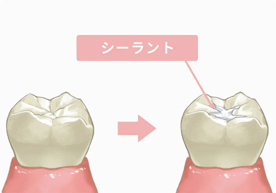 シーラント