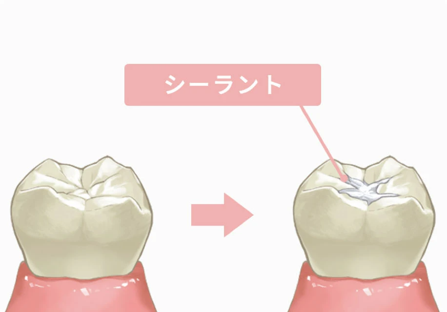 シーラント(お子さま)